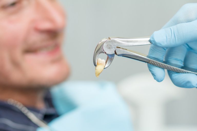 dentist extracted tooth from patient in clinic