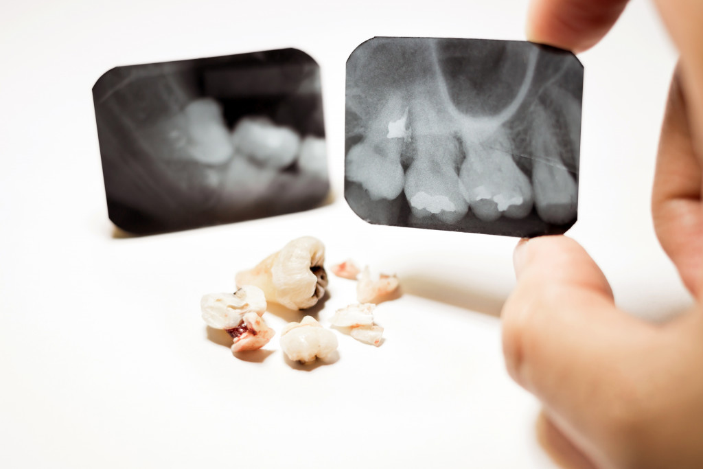 xray scan impacted tooth concept of dental trauma