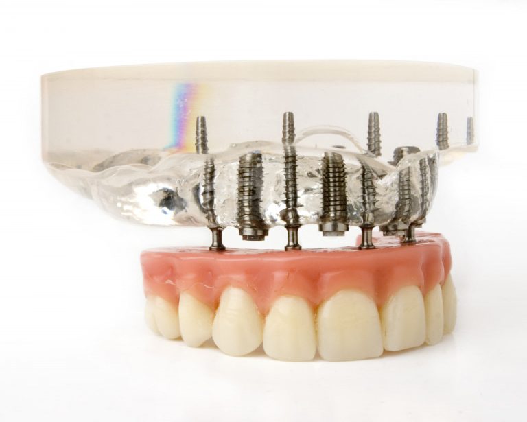 teeth implantation model