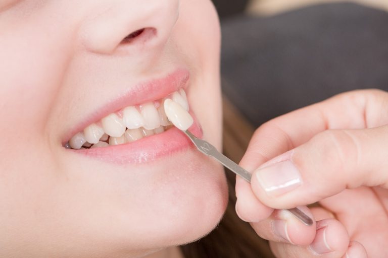 woman getting veneers