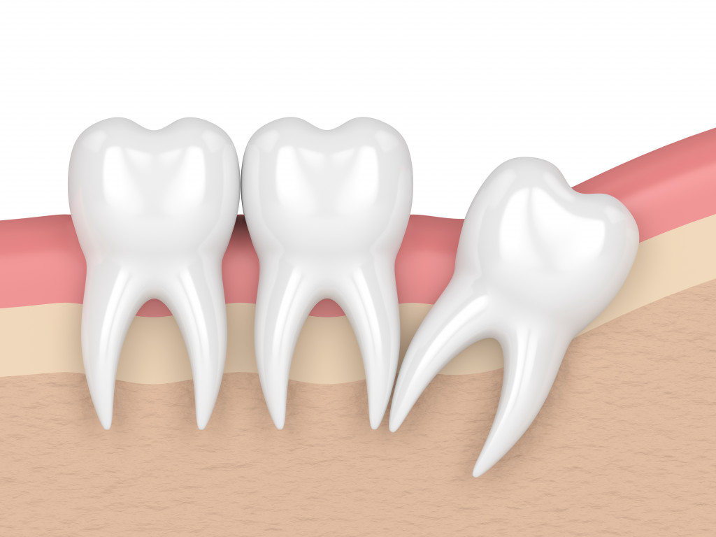 Impaction of wisdom tooth